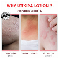 Utixira Lotion – Urticaria Relief Lotion